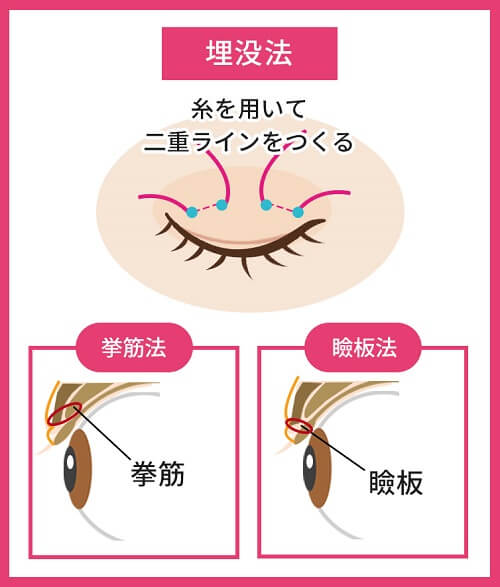 埋没法とは、医療用の糸を用いて二重を形成する施術