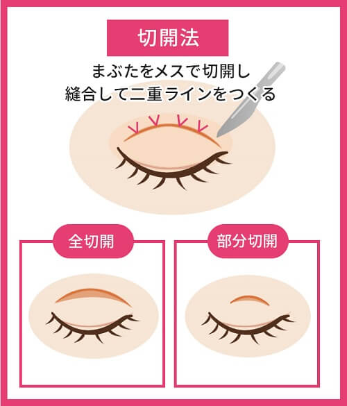 切開法とはまぶたをメスで切開して縫合糸て二重ラインを作る施術
