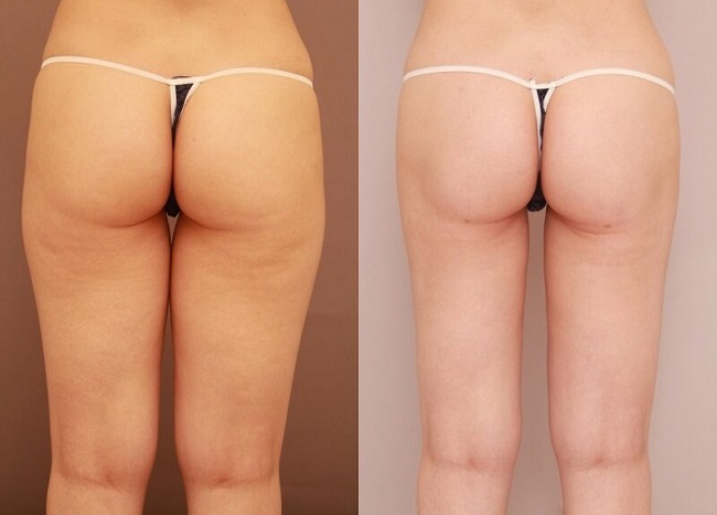 長野医師 太もも全周・臀部・膝のベイザー脂肪吸引症例