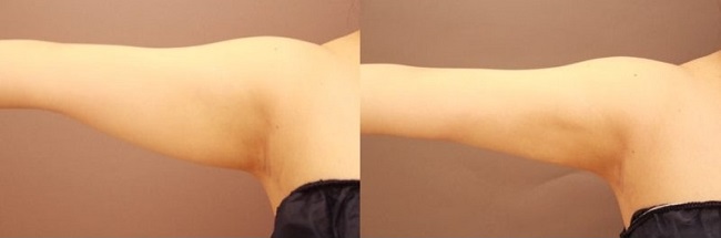 長野医師 二の腕・肩のベイザー脂肪吸引症例