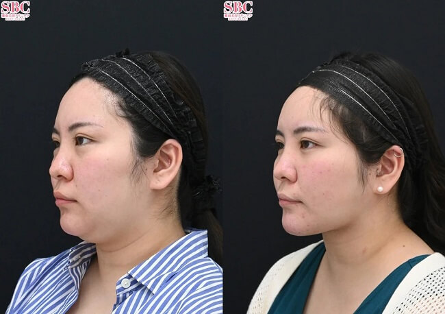 名倉俊輔医師ベイザー併用アキーセル脂肪吸引の症例写真