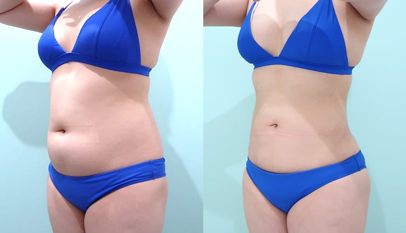 ワムクリニック佐々木和司医師の身体の脂肪吸引症例写真