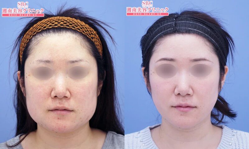 湘南美容クリニック秋葉原院の顔の脂肪吸引症例写真1