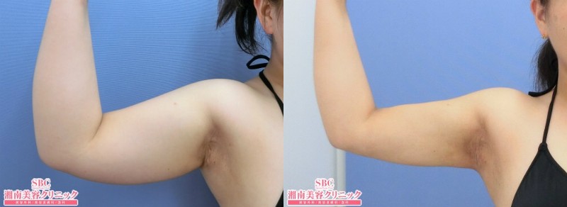 湘南美容クリニック秋葉原院二の腕の脂肪吸引症例1