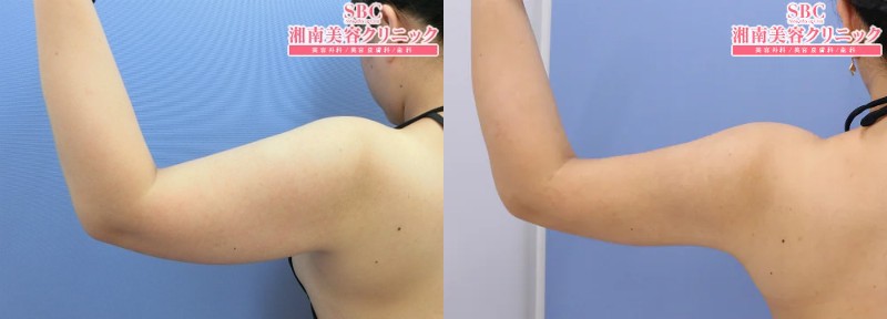 湘南美容クリニック秋葉原院二の腕の脂肪吸引症例2