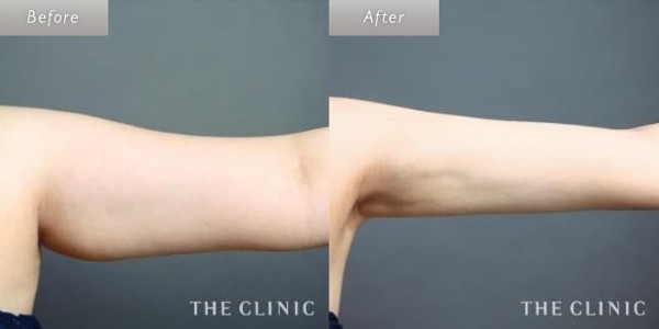 THECLINIC中居医師の二の腕の脂肪吸引症例写真