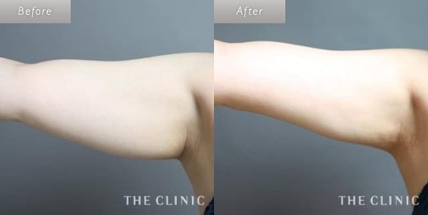 大橋 昌敬医師の二の腕の脂肪吸引症例写真