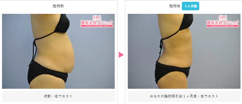 SBC竹田医師の脂肪吸引腹部の症例1
