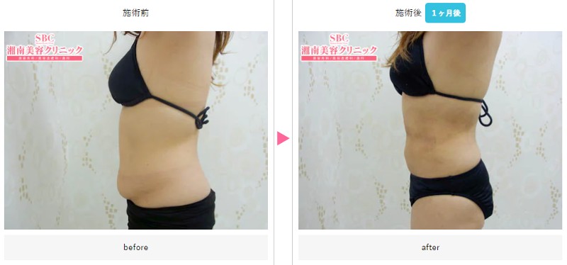SBC竹田医師：お腹の脂肪吸引の症例2