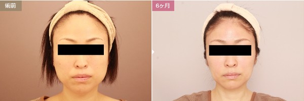 モッズクリニック東京院：顔の脂肪吸引症例写真①