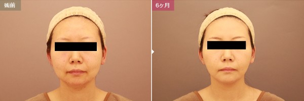 モッズクリニック東京院：顔の脂肪吸引症例写真②