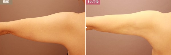 モッズクリニック東京院：二の腕の脂肪吸引症例写真①