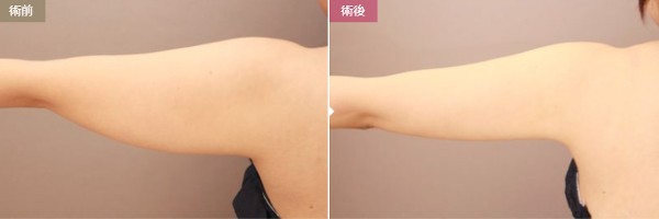 モッズクリニック東京院：二の腕の脂肪吸引症例写真②