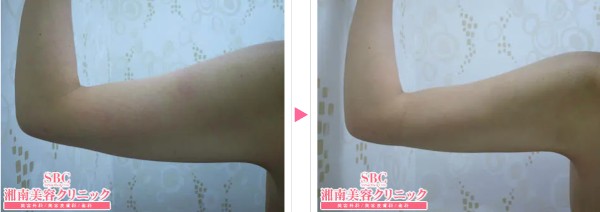 SBC新橋銀座口院：二の腕の脂肪吸引症例写真①