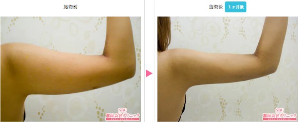 SBC新橋銀座口院：二の腕の脂肪吸引症例写真②